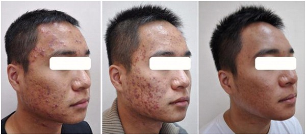 Before after acne scar surgery picture