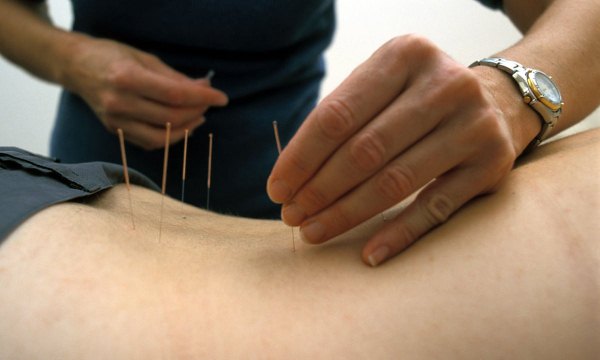 acupuncture back pain