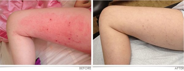 Eczema Legs