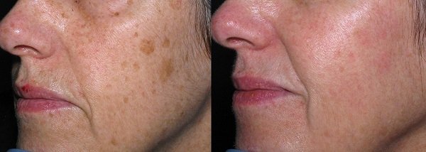 natural age spot remover on face