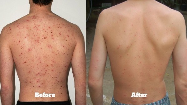 How to Get Rid of Bacne - Best Products to Treat Back Acne