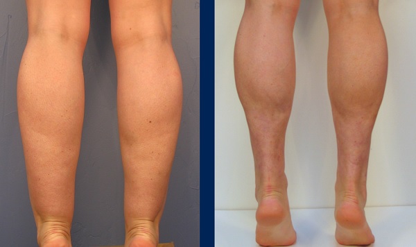 How to Get Rid of Cankles Fast → Get Skinny Ankles without surgery