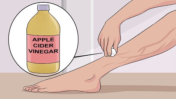 spider veins apple cider vinegar