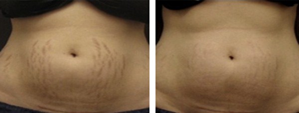 before after stretch marks