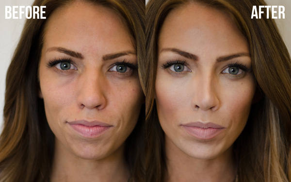 nose contour with fillers