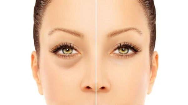 Causes, Symptoms and Treatments For Puffy Eyes