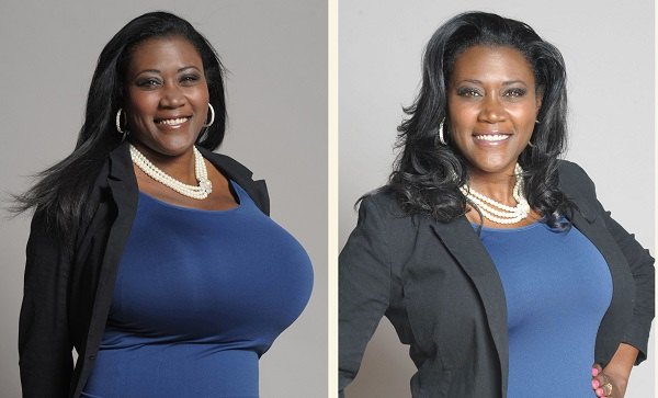 breast reduction before after