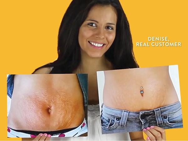 remove old stretch marks