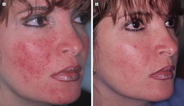 rosacea triggers treatments