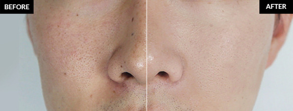 exfoliation before and after