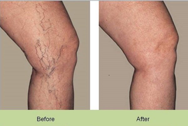 spider veins before after