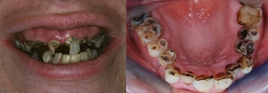 ugly teeth from drinking soda
