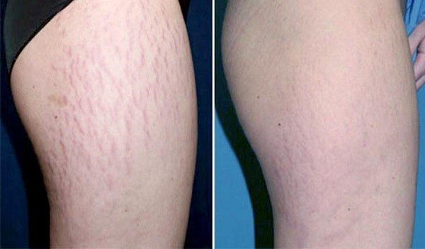 7 Essential Oils to Get Rid of Stretch Marks Fast